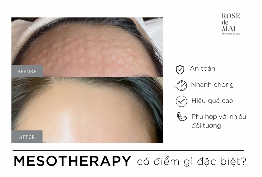 Mesotherapy